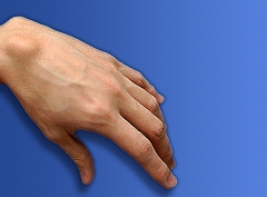 Ganglion Cyst