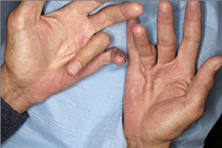 Dupuytren’s contracture